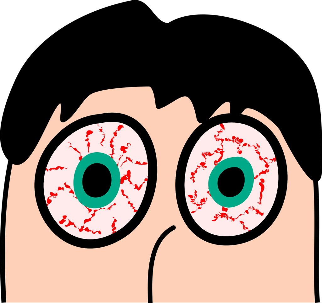 결막염의 대표적인 증상 중 하나인 안구 충혈 증상이 발생하여 눈의 흰자 주변에 붉은 혈관들이 부풀어 오른 상태를 보여주며 이러한 상태에서는 눈의 따끔거림과 가려움증을 동반할 수 있다.